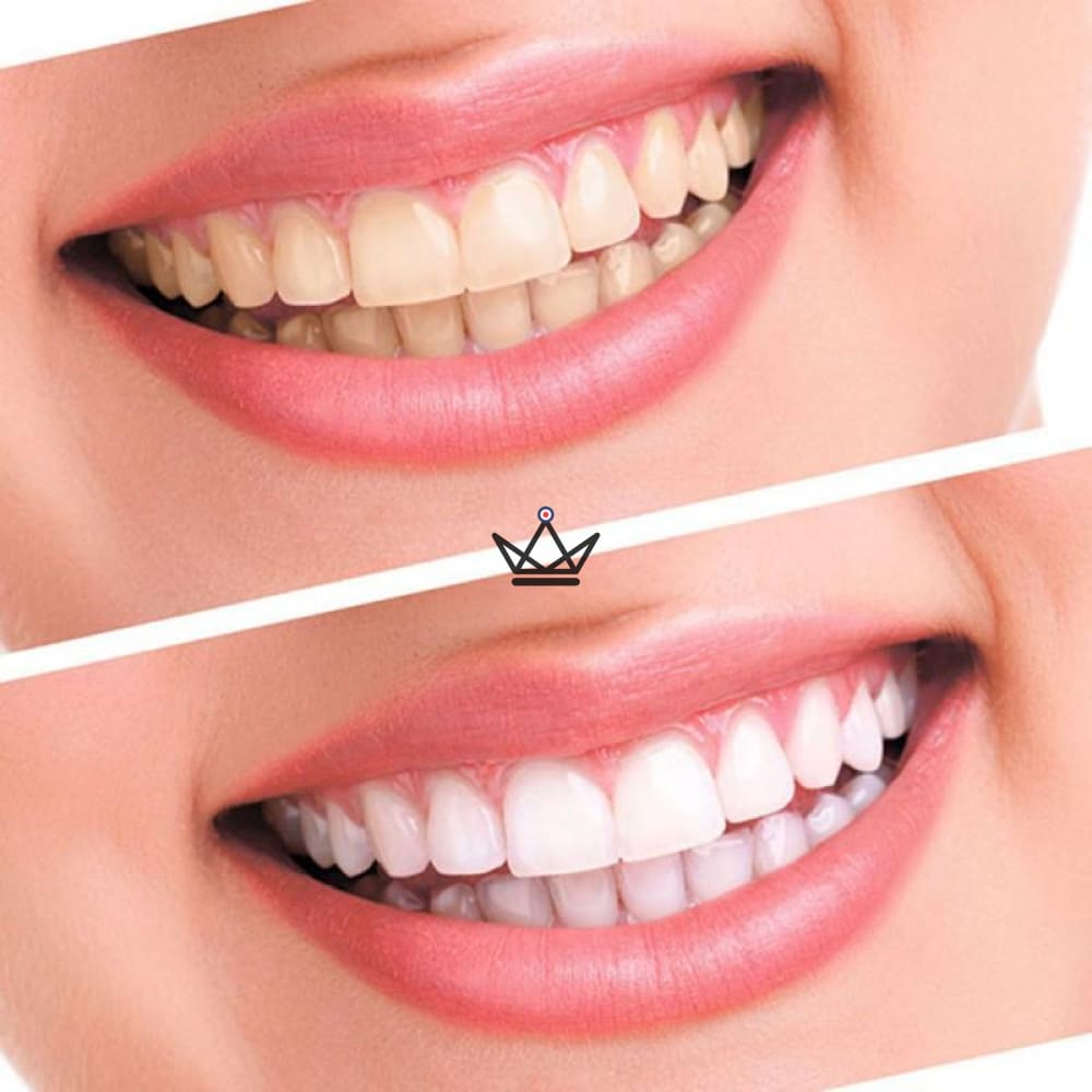 HAPPYDENTS - Blanqueamiento de dientes Kit - vista 2